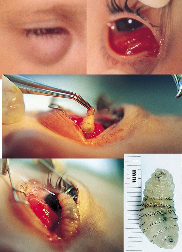 What are the treatment options for a human botfly infestation?
