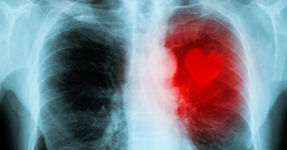 Chest x-ray with a red cartoon heart superimposed onto the ribcage.