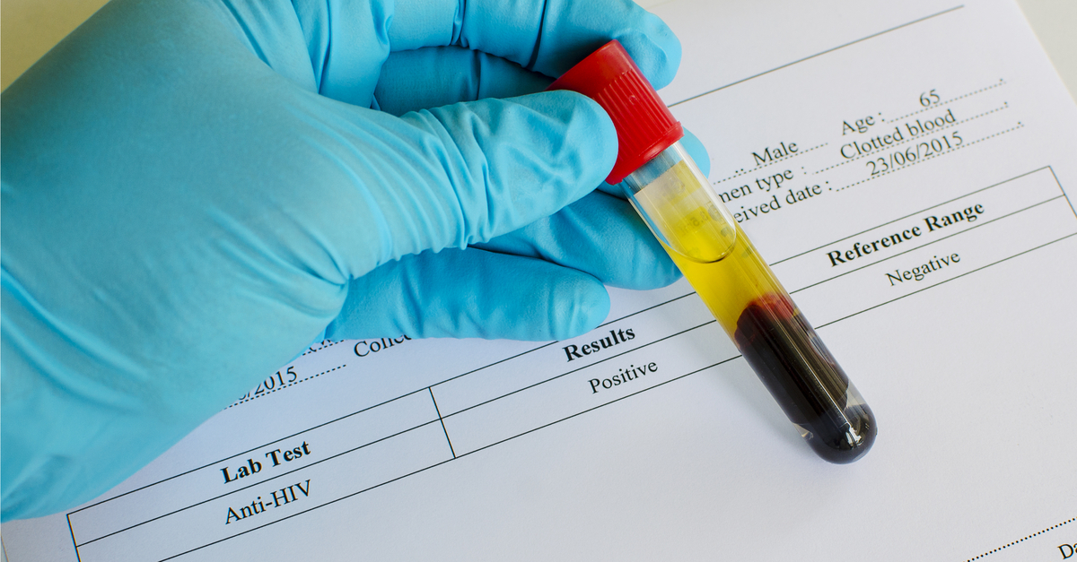 Blood sample with result sheet reading Anti-HIV Positive