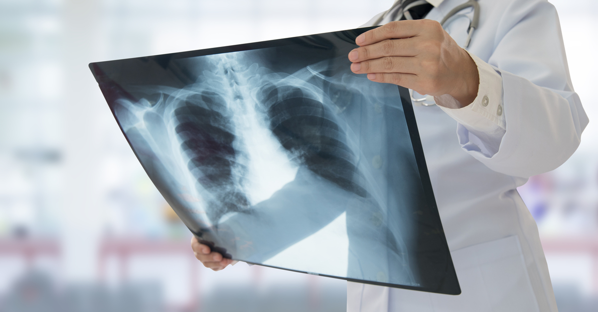 Doctor holding x-ray of lungs