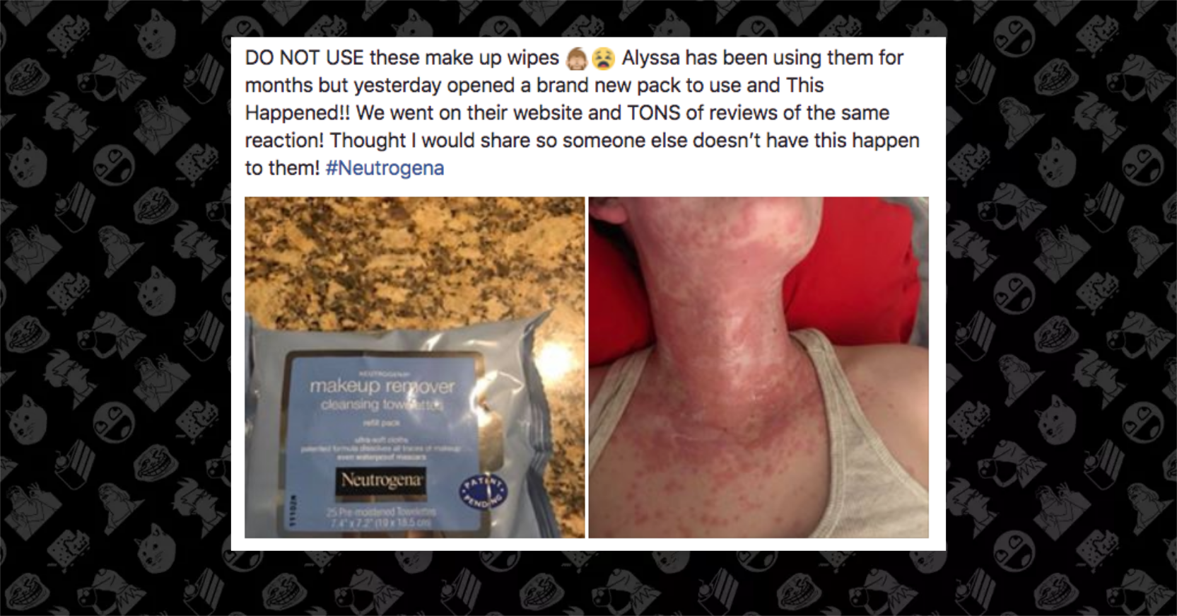 Are Neutrogena Makeup Remover Wipes Causing Allergic Reactions? Makeup Allergic Reaction