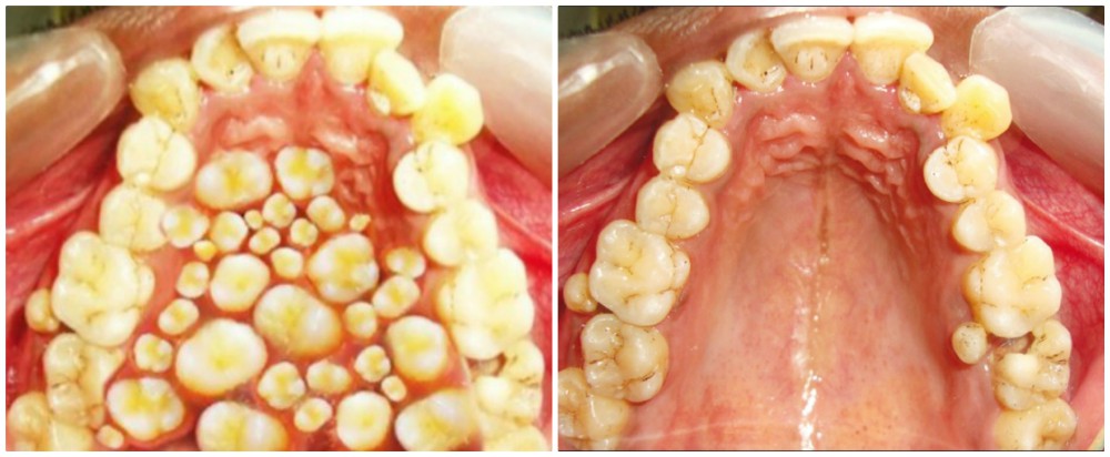 Does This Picture Show a Case of Hyperdontia? | Snopes.com