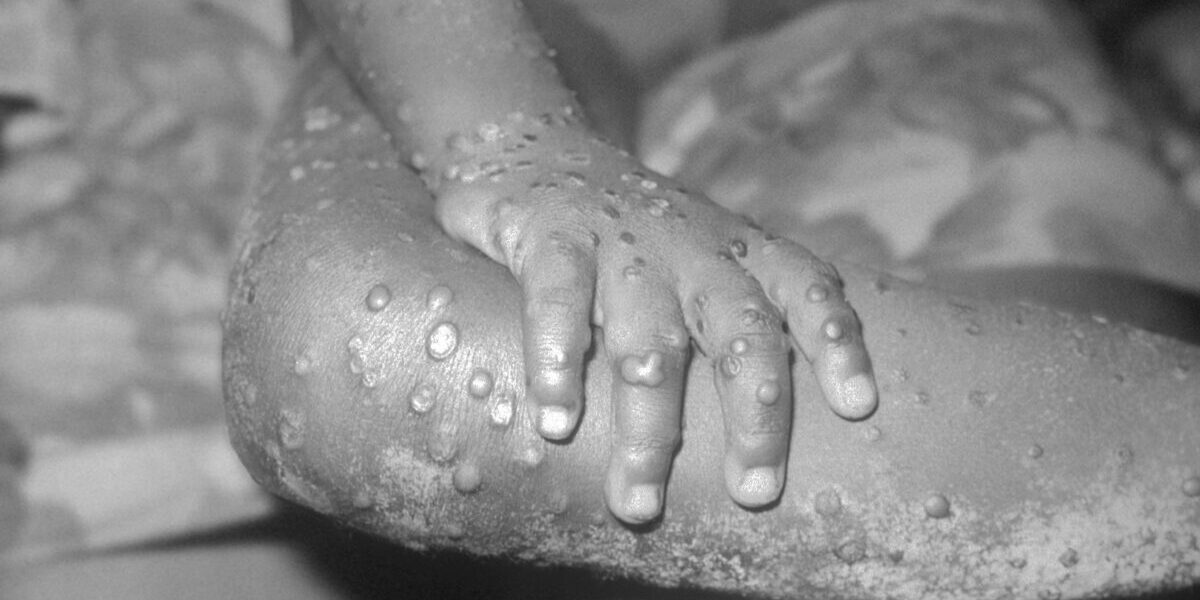 Can Monkeypox Be Considered an STD?