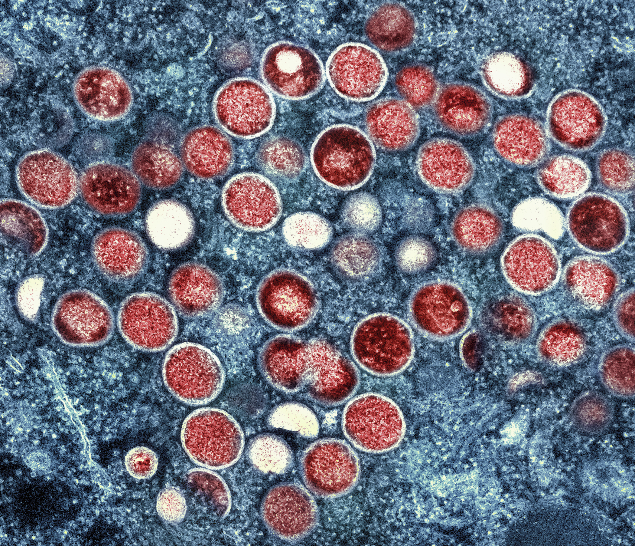 FILE - This image provided by the National Institute of Allergy and Infectious Diseases (NIAID) shows a colorized transmission electron micrograph of monkeypox particles (red) found within an infected cell (blue), cultured in the laboratory that was captured and color-enhanced at the NIAID Integrated Research Facility (IRF) in Fort Detrick, Md. On Friday, Aug. 12, 2022, The Associated Press reported on stories circulating online incorrectly claiming that monkeypox hasn't been detected in Georgia drinking water. The July 26 Atlanta-area news broadcast broadcast is being mischaracterized online to push the false claim that monkeypox has been found in residents’ tap water. (NIAID via AP)